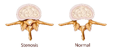 Darstellung einer Spinalkanalstenose