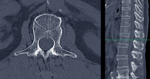 Osteoporotische Kompressionsfraktur im CT